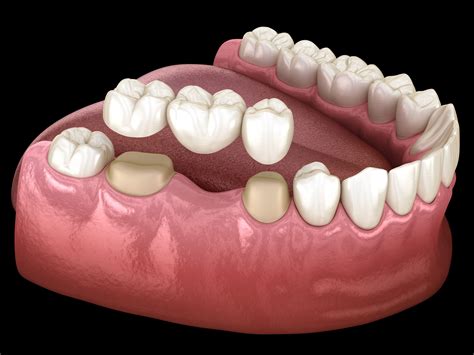 5 Tips For Choosing The Right Dental Bridge Specialist In Clayton Nc Dental Crowns Amp Bridges 5 Tips For Choosing The Right Dental Bridge Specialist In Clayton Nc Dental Crowns Amp Bridges