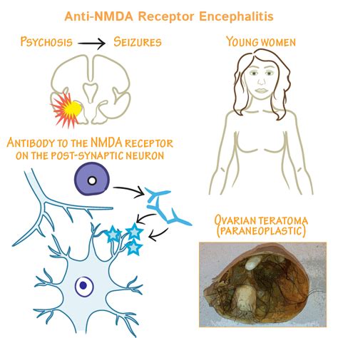 Anti Nmda Receptor Encephalitis A Synopsis Anti Nmda Receptor Encephalitis A Synopsis