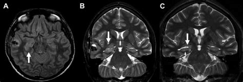 Anti Nmda Receptor Encephalitis Radiology Key Anti Nmda Receptor Encephalitis Radiology Key