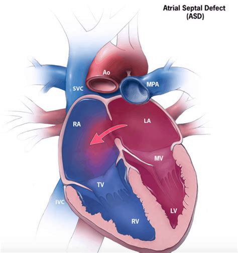 Atrial Septal Defect Asd Symptoms And Causes Penn Medicine Atrial Septal Defect Asd Symptoms And Causes Penn Medicine