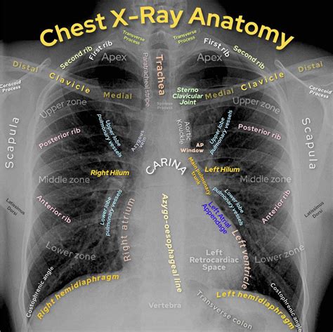 Basic Chest X Ray Interpretation Tips And Pointers To See It All Basic Chest X Ray Interpretation Tips And Pointers To See It All