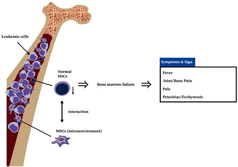 Biology And Therapeutic Properties Of Mesenchymal Stem Cells In Leukemia Biology And Therapeutic Properties Of Mesenchymal Stem Cells In Leukemia