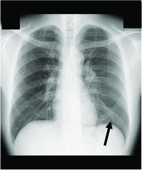 Bronchitis X Ray Bronchitis X Ray