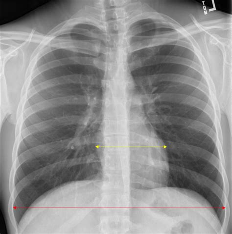 Chest Radiograph Saem Chest Radiograph Saem