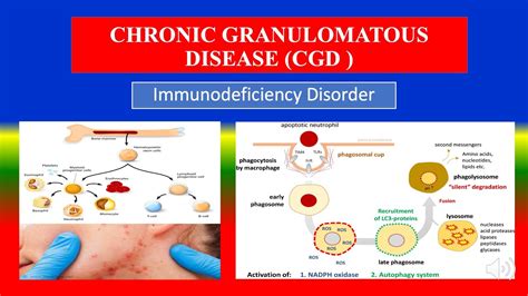 Chronic Granulomatous Disease Symptoms Actimmune Interferon Gamma 1B Hcp