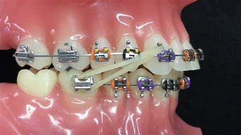 Class 2 Elastics Dental Braces Orthodontics Dentistry
