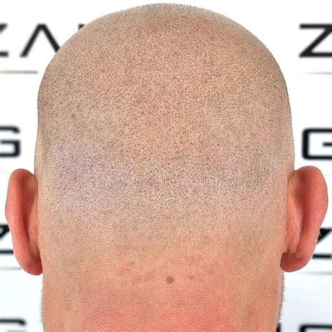 Comprehensive Scar Tattoo Cover Up Solutions Zang Smp