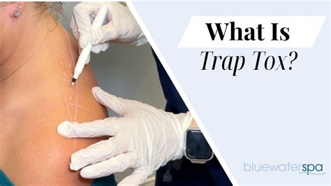 Considering Trap Tox Here Are A Few Things To Consider With All Cosmetic And Therapeutic Treatments A Comprehensive History And Assessment Is Important Save This Post For Your Reference Jill