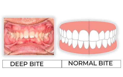 Deep Bite Correction Treatment Options In Scottsdale Az Deep Bite Correction Treatment Options In Scottsdale Az