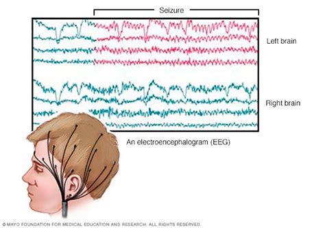 Eeg Electroencephalogram Mayo Clinic Eeg Electroencephalogram Mayo Clinic