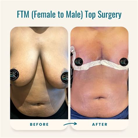 Ftm Top Surgery Results View Top Surgery Results Ftm Top Surgery Results View Top Surgery Results