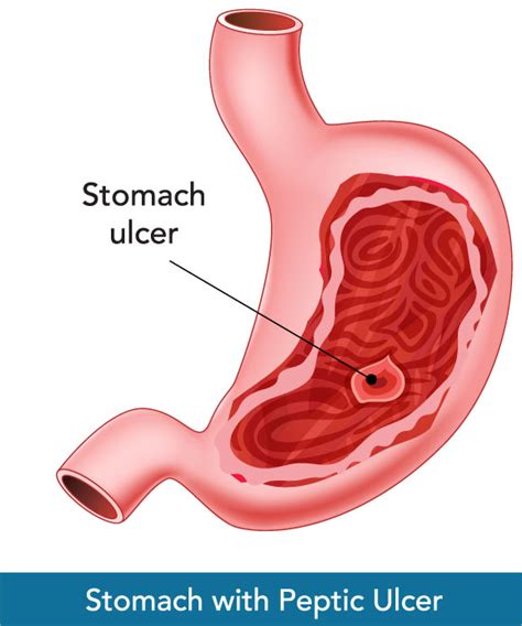 Gastric Ulcers Or Ulcers In The Stomach Are Damage To The Inner Surface Of The Stomach They Are A Common Occurrence In Horses Especially Sport And Racehorses Daniela Luethy Assistant Professor