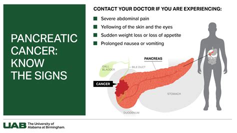 5 Pancreatic Cancer Facts