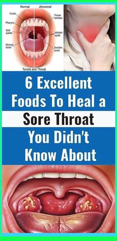 How To Heal Throat After Radiation At Beverly Wesson Blog