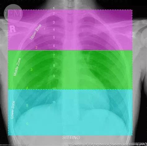 How To Read Chest X Rays International Emergency Medicine Education Project How To Read Chest X Rays International Emergency Medicine Education Project