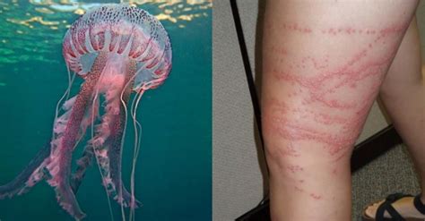 Jellyfish Sting Think Twice