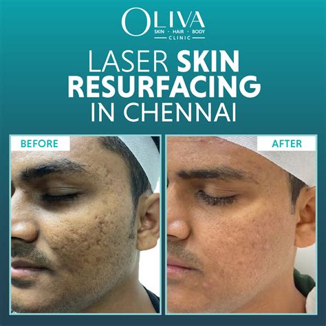 Laser Scar And Stretch Mark Resurfacing Lviv Novosilska Clinic Skin Renewal