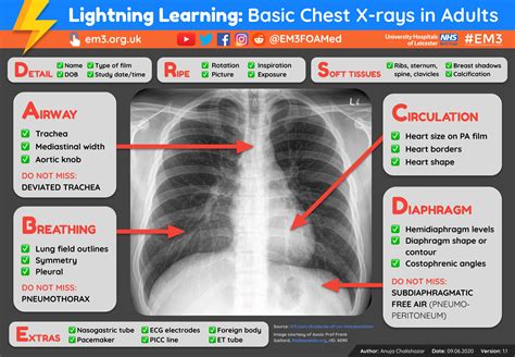 Lightning Learning Basic Chest X Rays In Adults Em3 Lightning Learning Basic Chest X Rays In Adults Em3