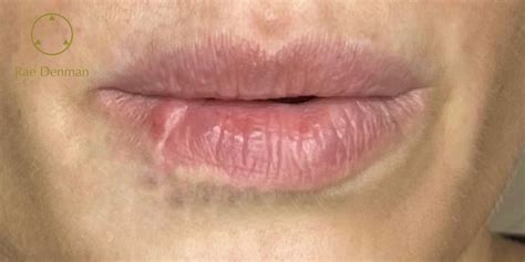 Lip Scar Removal and Treatment Options
