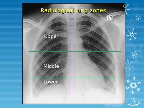 Lung Zone X Ray Lung Zone X Ray