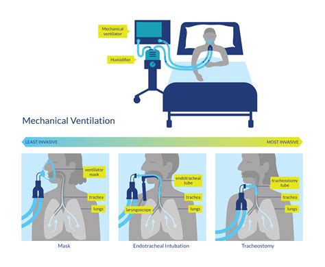Mechanical Ventilation Oversimplified Nuem Blog
