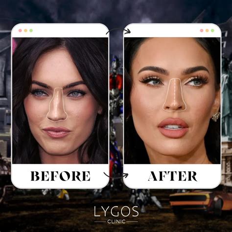 Megan Fox Rhinoplasty Surgery Celebrities Nose Job Megan Fox Rhinoplasty Surgery Celebrities Nose Job