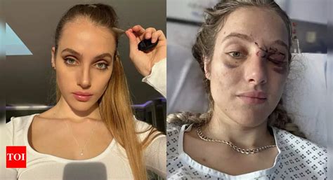 Neuroscientist Turned Onlyfans Model Can T Remember Who She Is After A Near Fatal Bike Accident The Times Of India Neuroscientist Turned Onlyfans Model Can T Remember Who She Is After A Near Fatal Bike Accident The Times Of India