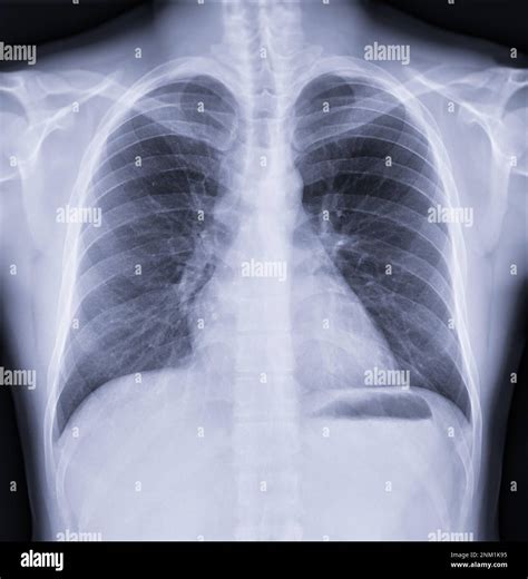 5 Ways Normal Chest X Ray