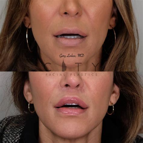 Nyc Lip Lift Revision Surgery Ues Lip Lift Scar Repair Cosmetic Surgery