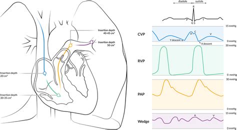 Placement Of The Pac Guided By The Characteristics Of Normal Vascular Download Scientific Diagram