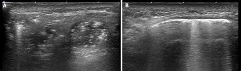 Pneumoparotid With Imaging Findings A Case Report And Review Of Literature