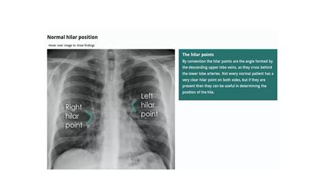 Ppt Chest X Ray Ppt Chest X Ray
