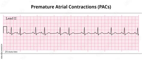Premature Atrial Contractions Pacs 12 Lead Ecg Resources Acls Certification Association