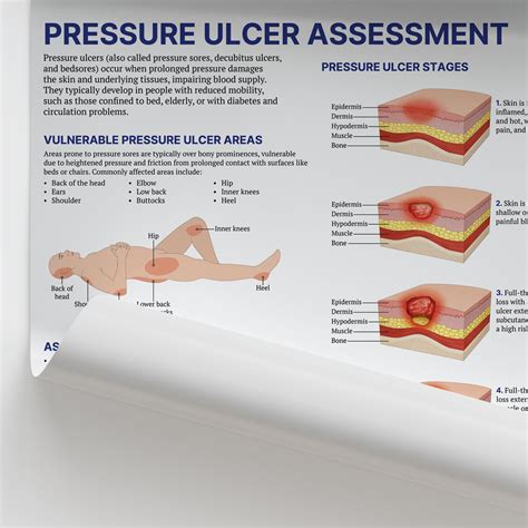 Pressure Ulcer Posterboard Pressure Ulcer Posterboard