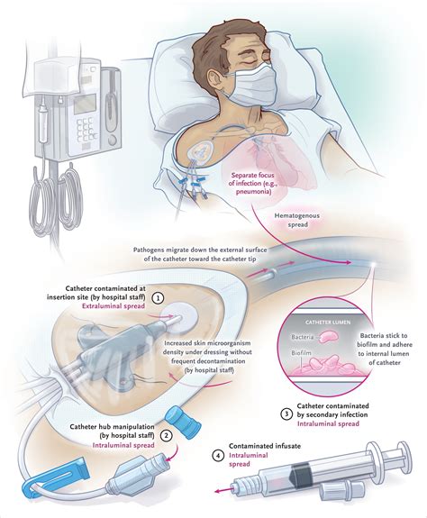 Prevention Of Central Line Associated Bloodstream Infections New England Journal Of Medicine