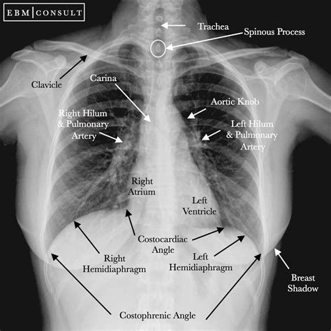 Radiology Thorax Normal Radiology Thorax Normal