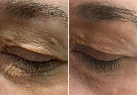 Scar Removal In London Dermasurge On Harley Street