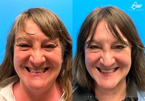 Scar Revision Before After Photos Law Plastic Surgery