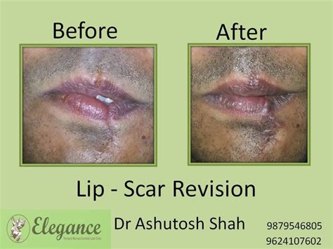 Scar Treatment Lip Scar Treatment In Ranchi Micro Scar Revision Surgery By Dr Pankaj Kumar