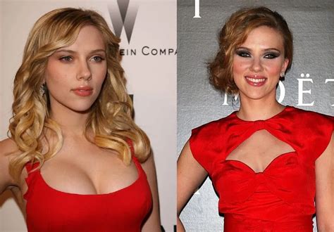 Scarlett Johansson Breast Reduction Dramatic Changes Explained