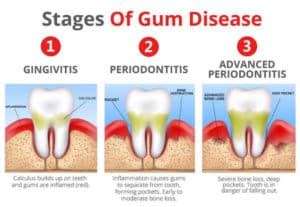 Symptoms Of A Gum Disease Sioux City Ia Whispering Creek