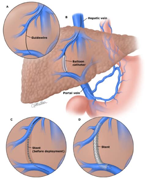 Tip S Ing The Scales Against Portal Hypertension Aasld Tip S Ing The Scales Against Portal Hypertension Aasld