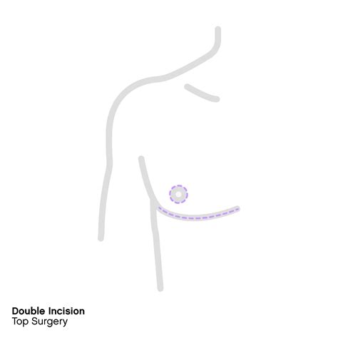 Top Surgery 101 Procedures Cost And Safety By Folx Top Surgery 101 Procedures Cost And Safety By Folx