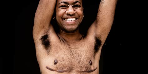 Top Surgery Scars Types Scar Treatments Cover Up Tattoos Ps Beauty Top Surgery Scars Types Scar Treatments Cover Up Tattoos Ps Beauty