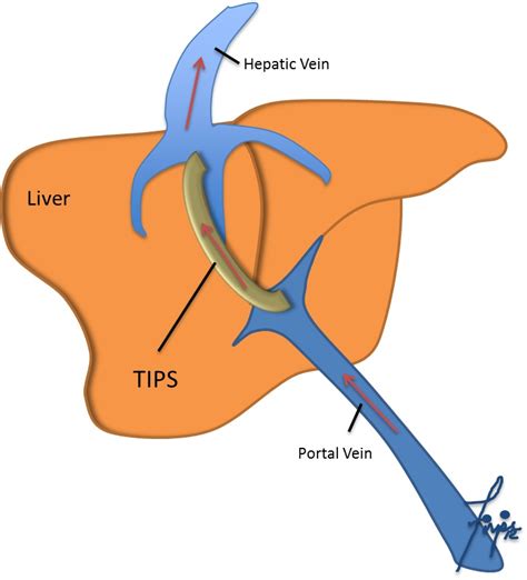 Transjugular Intrahepatic Portosystemic Shunt Tips Penn Medicine Transjugular Intrahepatic Portosystemic Shunt Tips Penn Medicine