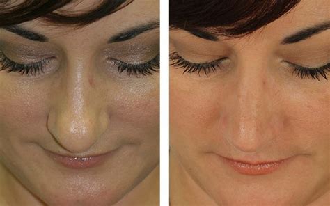 Treating The Bulbous Nasal Tip Dr Anil Shah Chicago Il