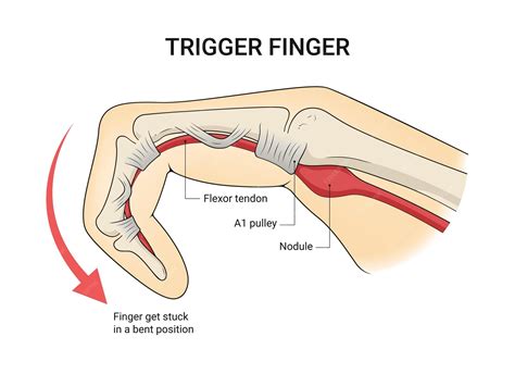 Trigger Finger Emergeortho S Dr Rader Discusses Trigger Finger Causes Symptoms And Treatment
