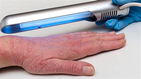 Uv Light Therapy For Eczema At Home Benefits Risks Alternatives