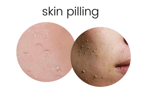What Is Pilling In Skincare What Is Pilling In Skincare