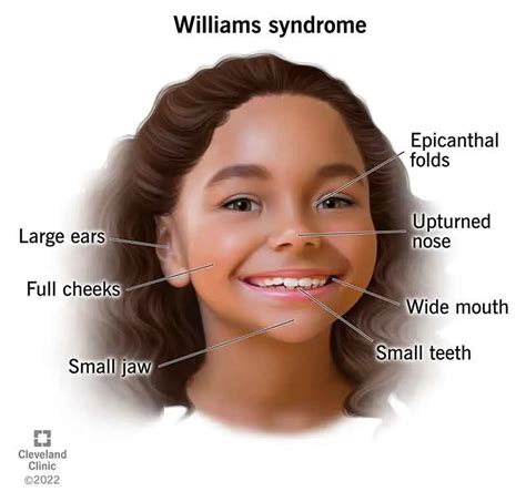 Williams Syndrome Paediatricfoam